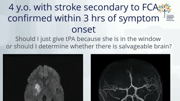 Perfusion imaging and cerebrovascular reserve measurement in children - Mark Mackay