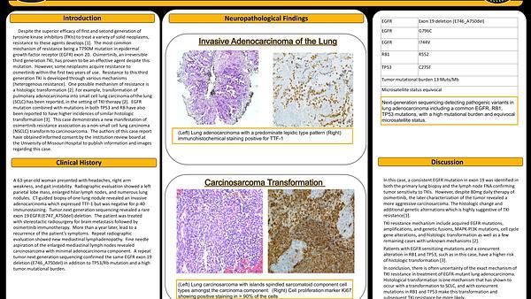 EGFR-mutated lung adenocarcinoma transformation to carcinosarcoma as an osimertinib resistance mechanism