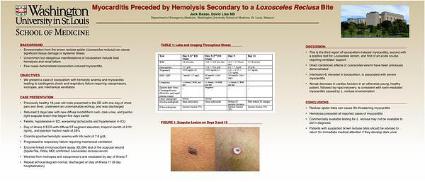 Myocarditis Preceded by Hemolysis Secondary to a Loxosceles Reclusa Bite