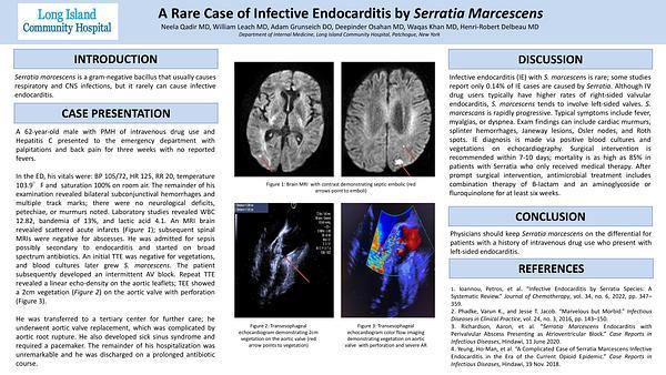 A Rare Case of Infective Endocarditis by Serratia Marcescens