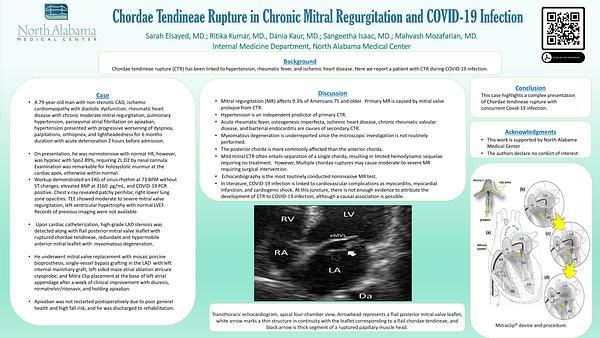 Chordae Tendineae Rupture in Chronic Mitral Regurgitation and COVID-19 Infection
