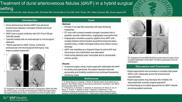 Treatment of a dural arteriovenous fistulas (dAVF) in a hybrid surgical setting: