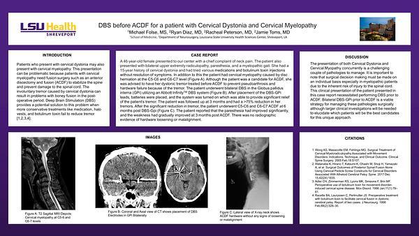 DBS before ACDF for a patient with Cervical Dystonia and Cervical Myelopathy