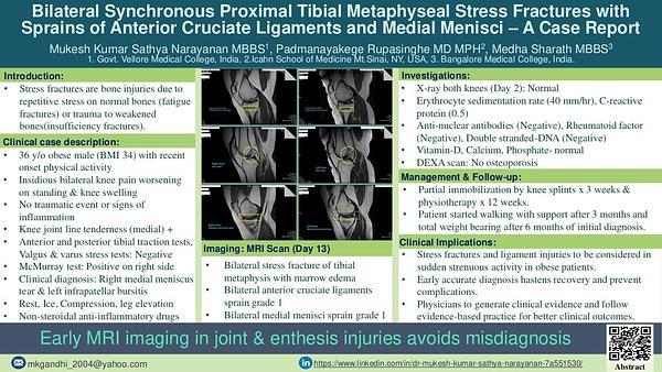 Bilateral Synchronous Proximal Tibial Metaphyseal Stress Fractures with Sprains of Anterior Cruciate Ligaments and Medial Menisci – A Case Report