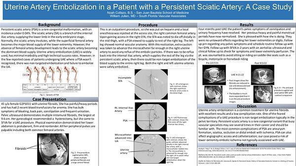 Uterine Artery Embolization in a Patient with a Persistent Sciatic Artery