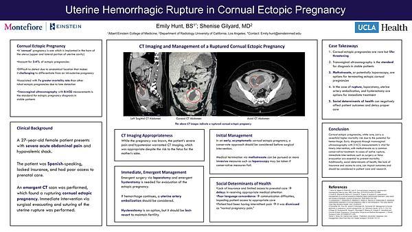 Uterine Hemorrhagic Rupture in Cornual Ectopic Pregnancy​